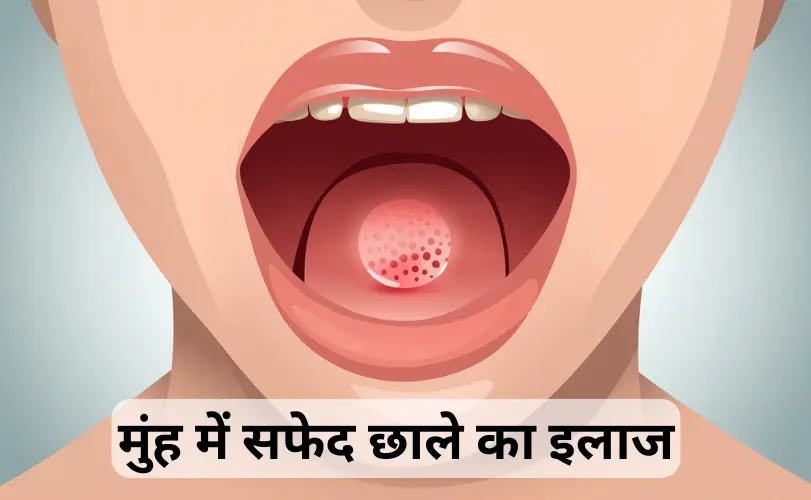 मुंह में सफेद छाले का इलाज gharelu upay | Muh ke chale kaise thik kare